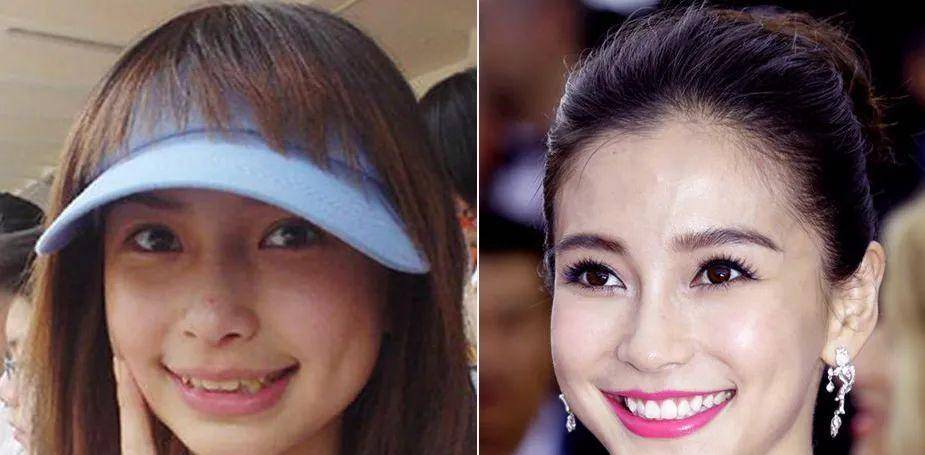 明星矯正牙齒之路，從過(guò)往經(jīng)歷看現(xiàn)代影響