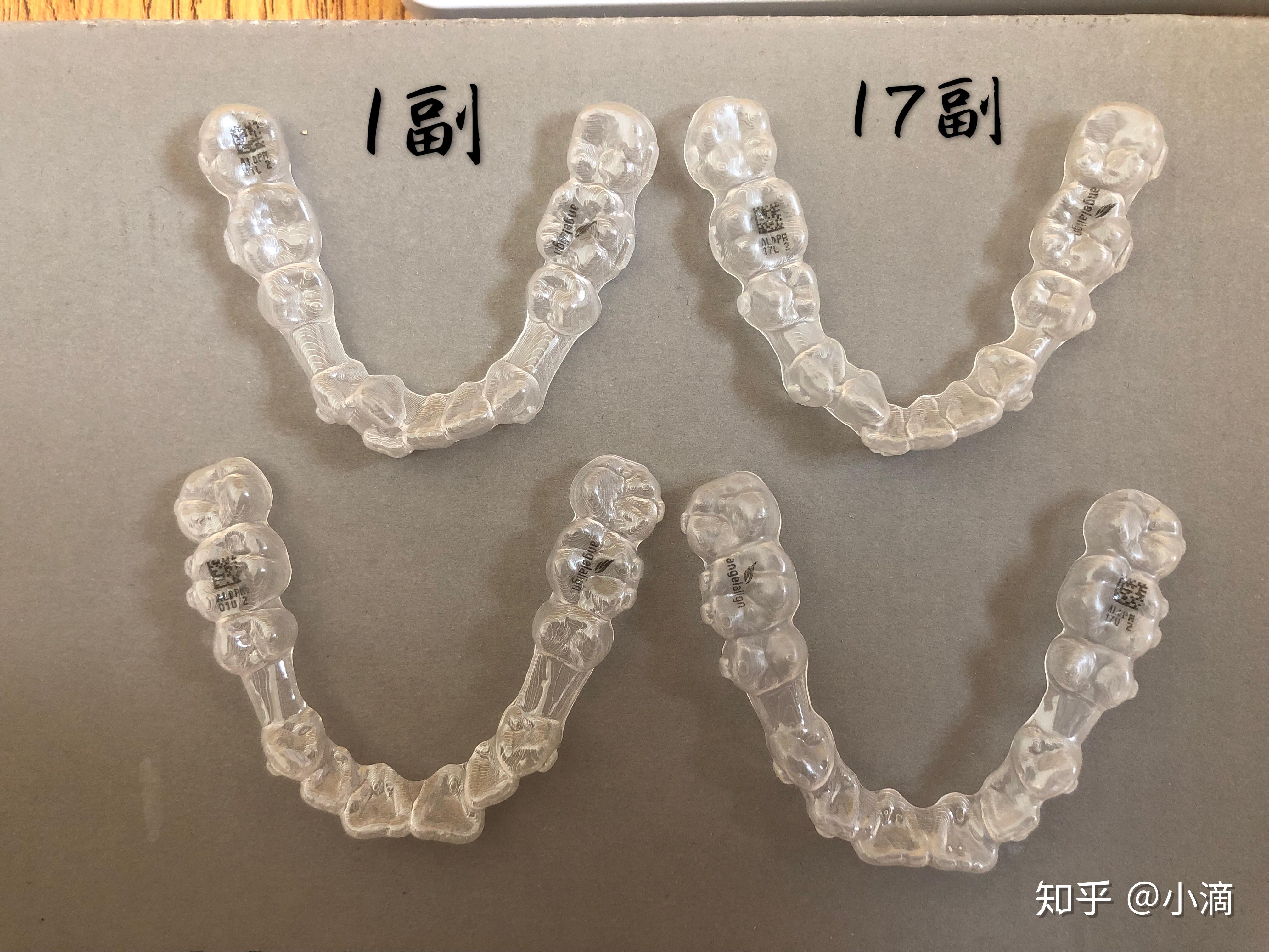 時代天使牙套價格揭秘，小巷中的美麗蛻變之旅啟動！