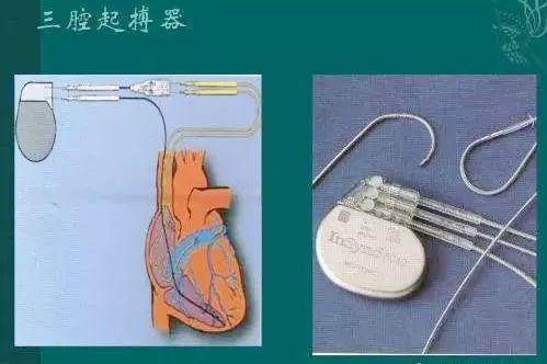 三腔起搏器價格及壽命解析