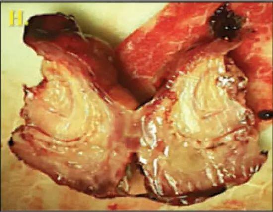 小明康復之旅，最新病例報道與友情的溫暖紐帶